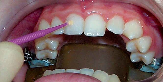 Imagen de aplicar adhesivo a los dientes.

