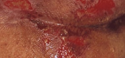 pressure injury