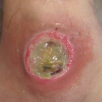 dressings