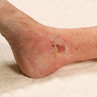 venous leg ulcer
