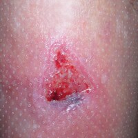 foam dressing