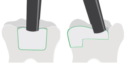 illustration of teeth showing placement
