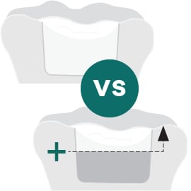 Filtek™ Bulk Fill Posterior Restorative capping comparison to SureFil® SDR® flow
